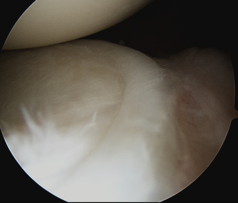 Shoulder Arthroscopy Inferior Labrum